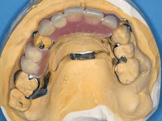 Partial Co-Cr denture
